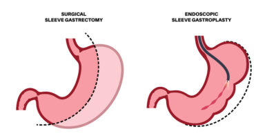 Gastrectomy and gastroplasty