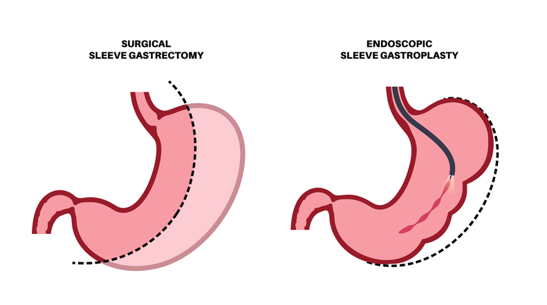 Gastrectomy and gastroplasty